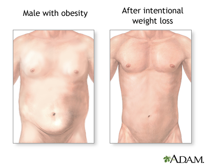 Which Fasting Type is Best For Weight Loss?